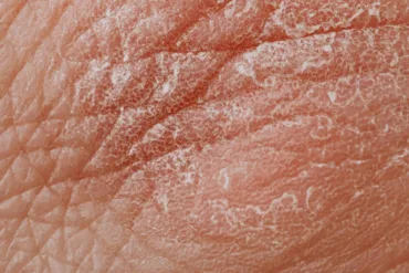 Seasonal Stressor Plan