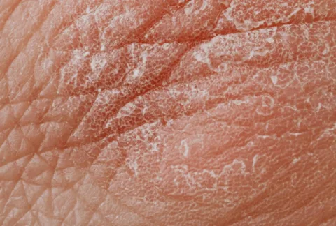 Common signs of food sensitivity including skin issues, bloating, fatigue, and digestive discomfort